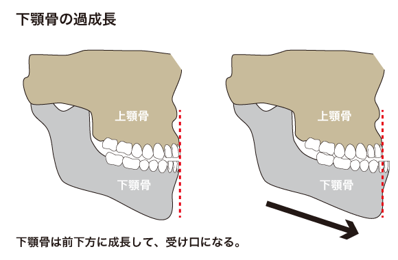 下顎骨の過成長