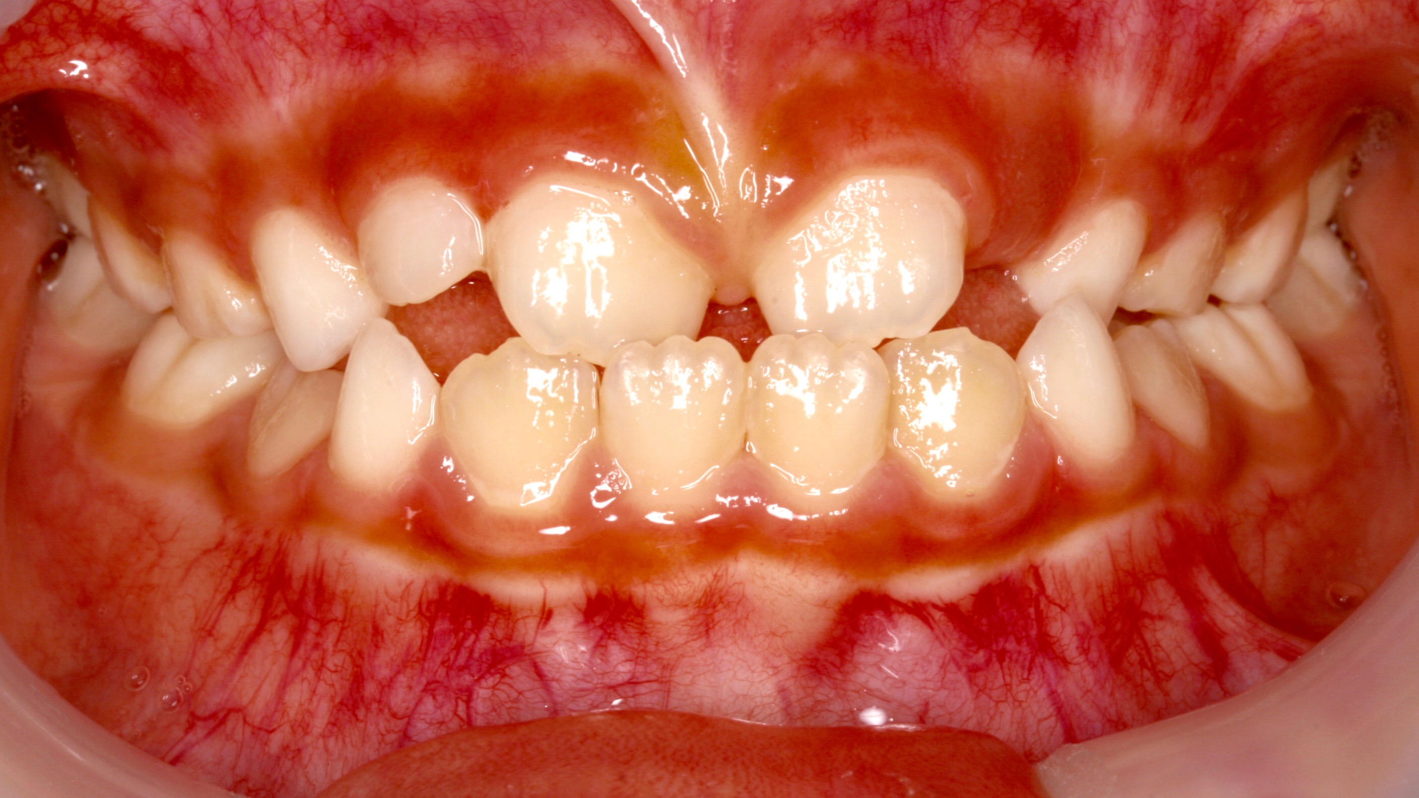 下アゴの大きい子(受け口の子)の矯正について