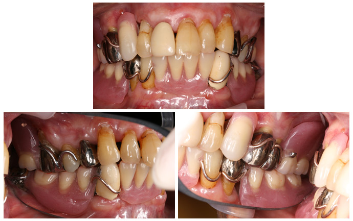 入れ歯を装着したところの写真