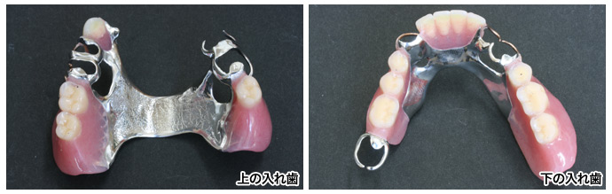 上下の入れ歯写真