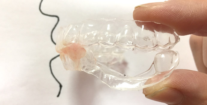 マウスピースを使用した治療