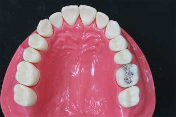 歯を失ってしまうパターン