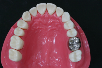 歯を失ってしまうパターン