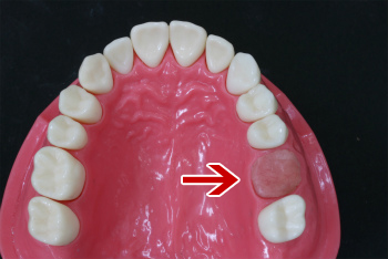 歯を失ってしまうパターン