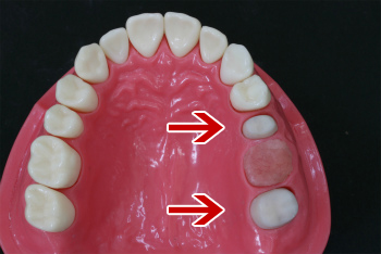 歯を失ってしまうパターン