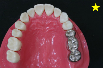 歯を失ってしまうパターン