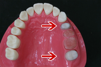 歯を失ってしまうパターン
