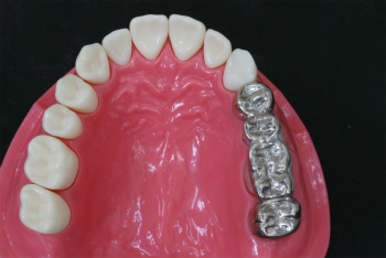 歯を失ってしまうパターン