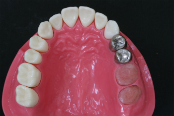 歯を失ってしまうパターン