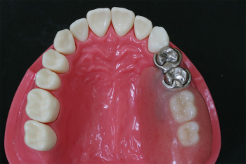 歯を失ってしまうパターン