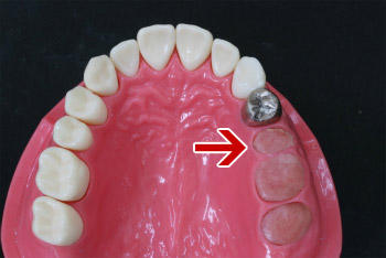 歯を失ってしまうパターン