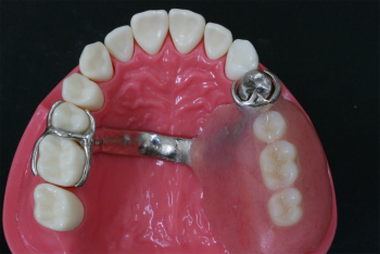 歯を失ってしまうパターン