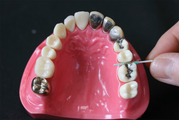 歯を次第に失っていくのをストップするには