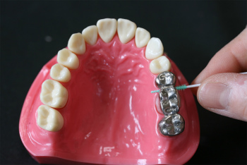 歯を次第に失っていくのをストップするには