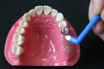 歯を次第に失っていくのをストップするには