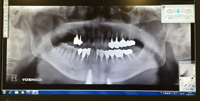 デジタルレントゲン