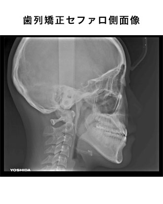 歯列矯正セファロ側面像