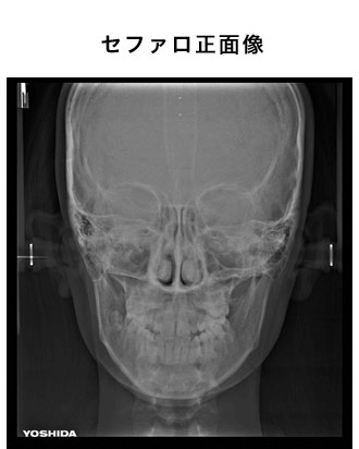 セファロ正面像