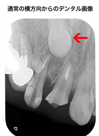 通常の横方向からのデンタル画像