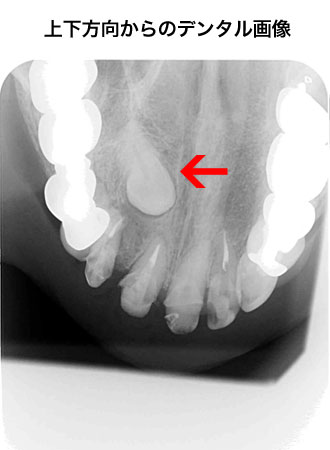 通常の横方向からのデンタル画像
