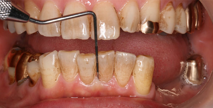 病気の進行度は次のように判断します。
