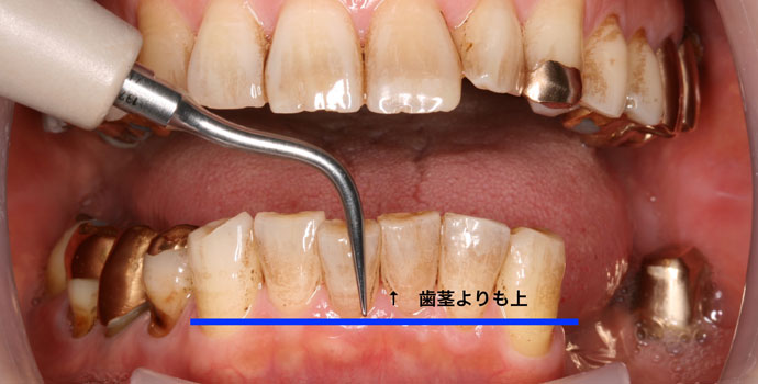 歯周病の治療について知っていただきたいこと