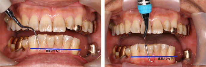 歯茎の中についている歯石