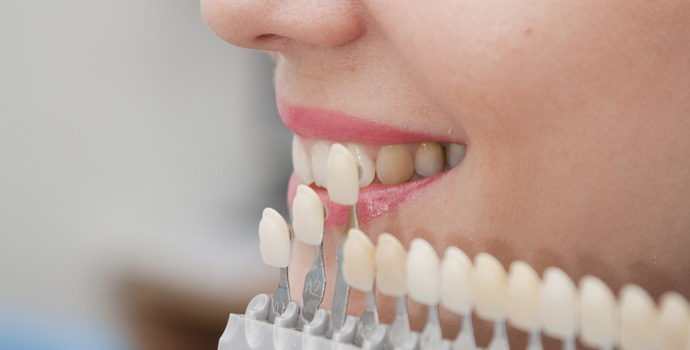 ホワイトニング